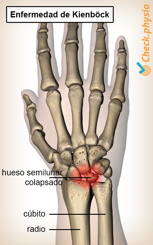 muñeca enfermedad de Kienbock hueso carpiano semilunar