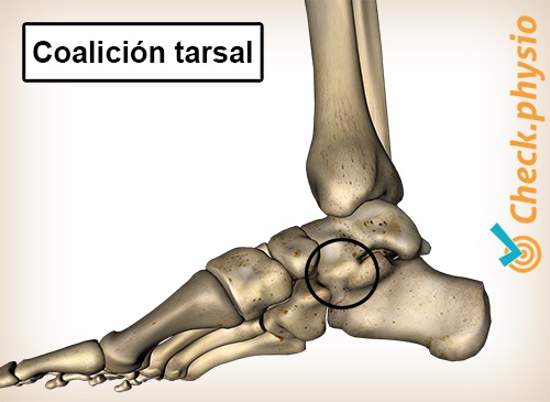 pie coalición tarsal medial interior