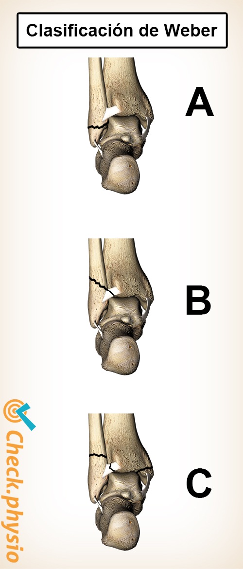 fractura tobillo roto clasificación Weber a b c