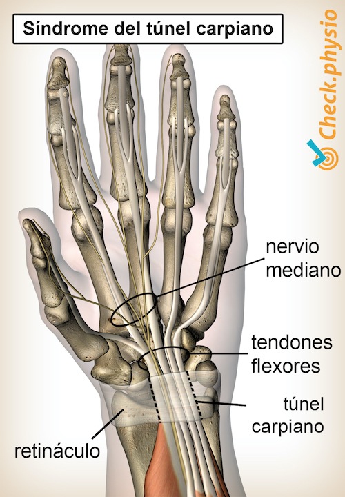 mano síndrome del túnel carpiano pinzamiento carpiano