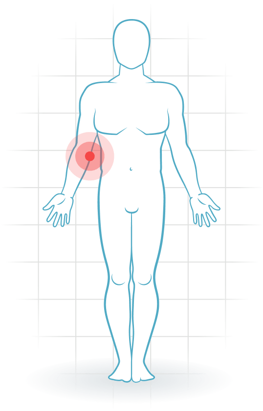 pijnlocatie Lesión del ligamento colateral interno del codo