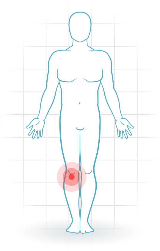pijnlocatie Rodilla del saltador