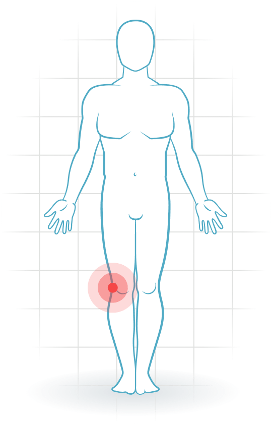 pijnlocatie Lesión del ligamento lateral de la rodilla