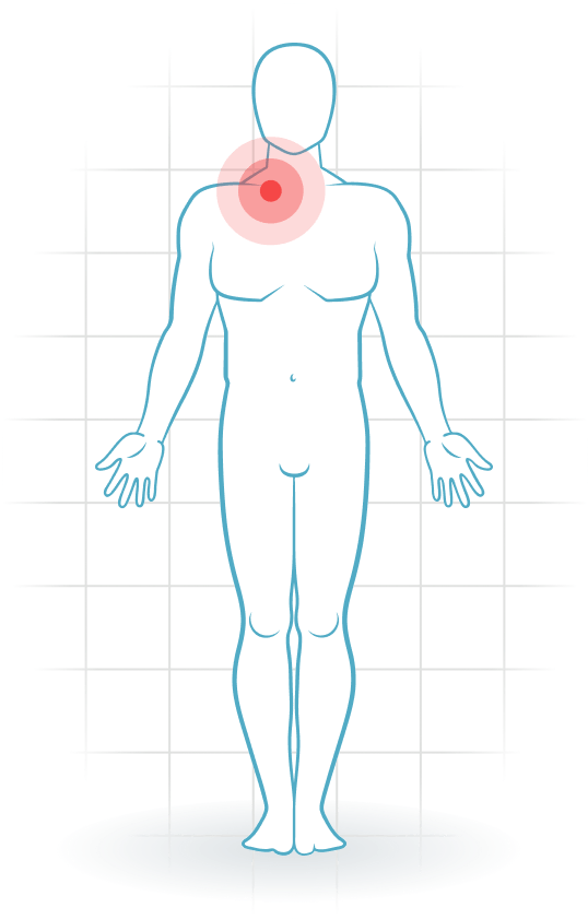 pijnlocatie Lesión esternoclavicular